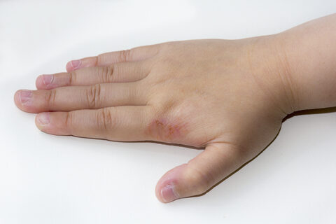 kézfej bőrbetegségei