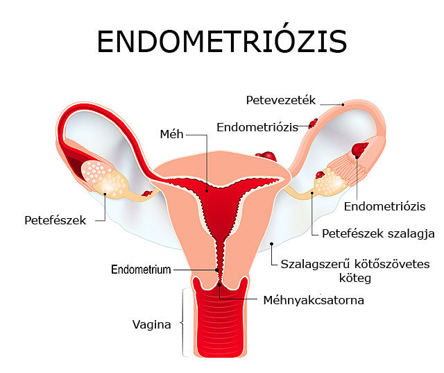 Endometriózis a női nemi szerveken
