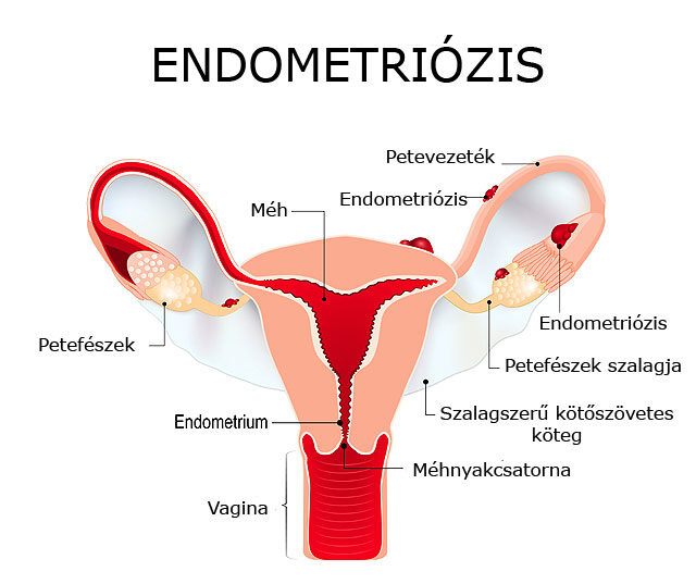 hogyan lehet fogyni az endometriózis