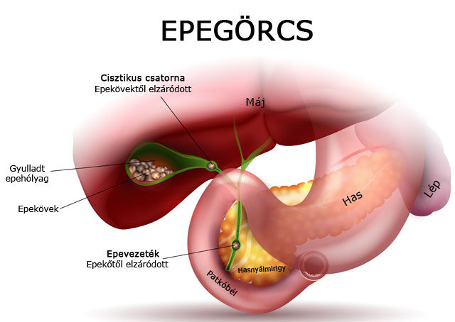 Epegörcs kialakulása