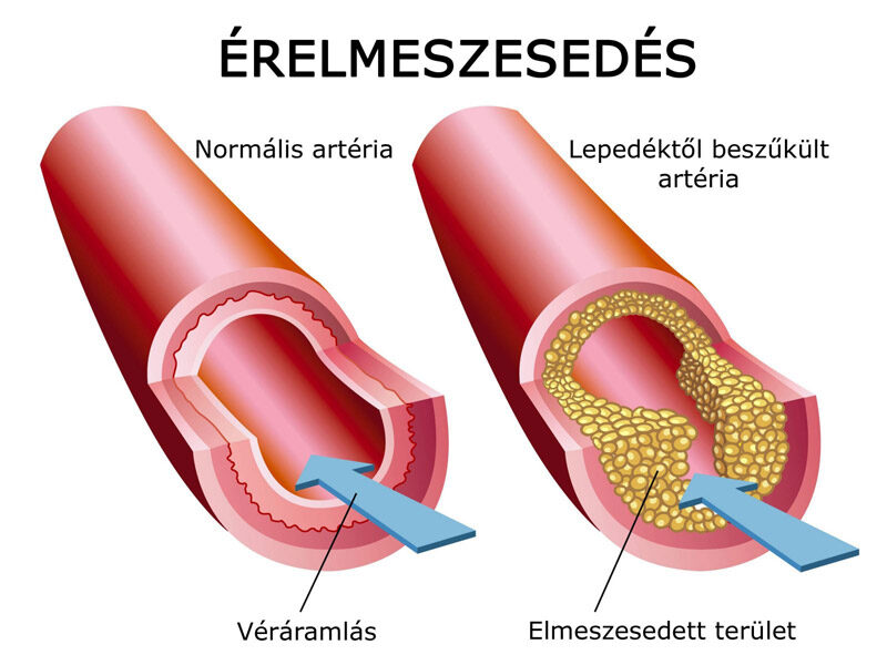 érelmeszesedés érszűkület tünetei)