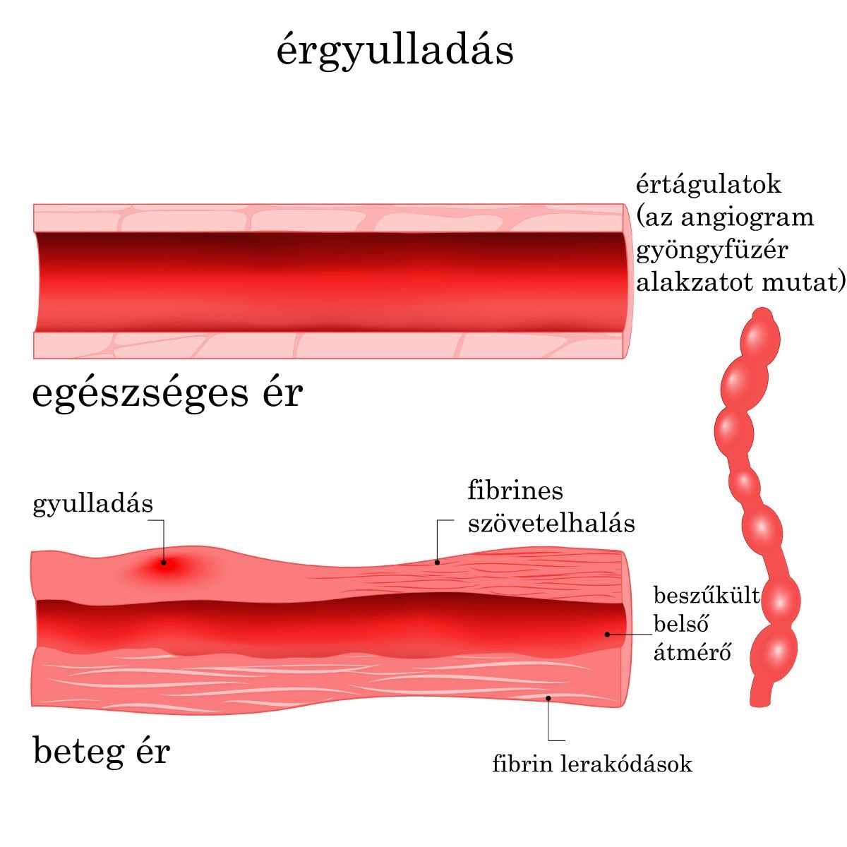 érgörcs hipertónia)