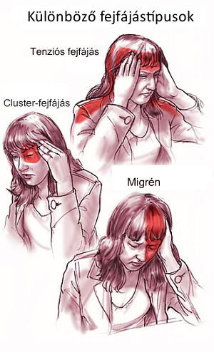 Különböző fejfájástípusok; Kép forrása: 