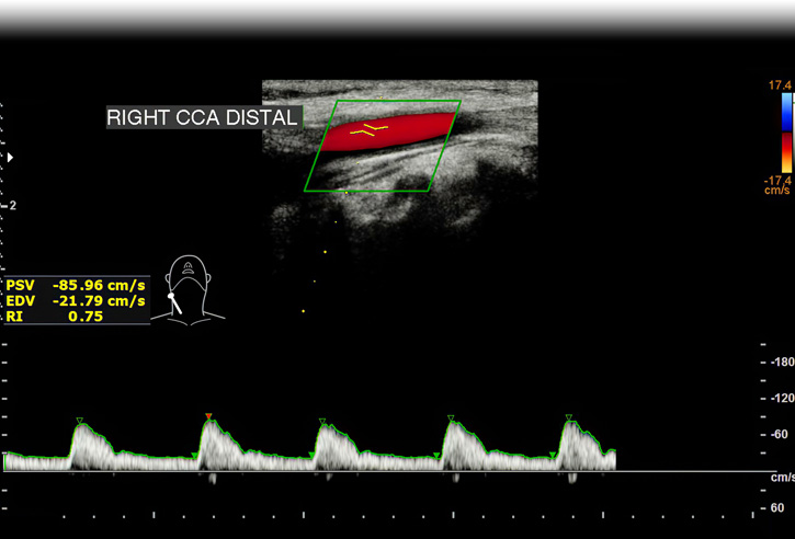 A fő nyaki artériák (carotisok) Doppler-vizsgálata 