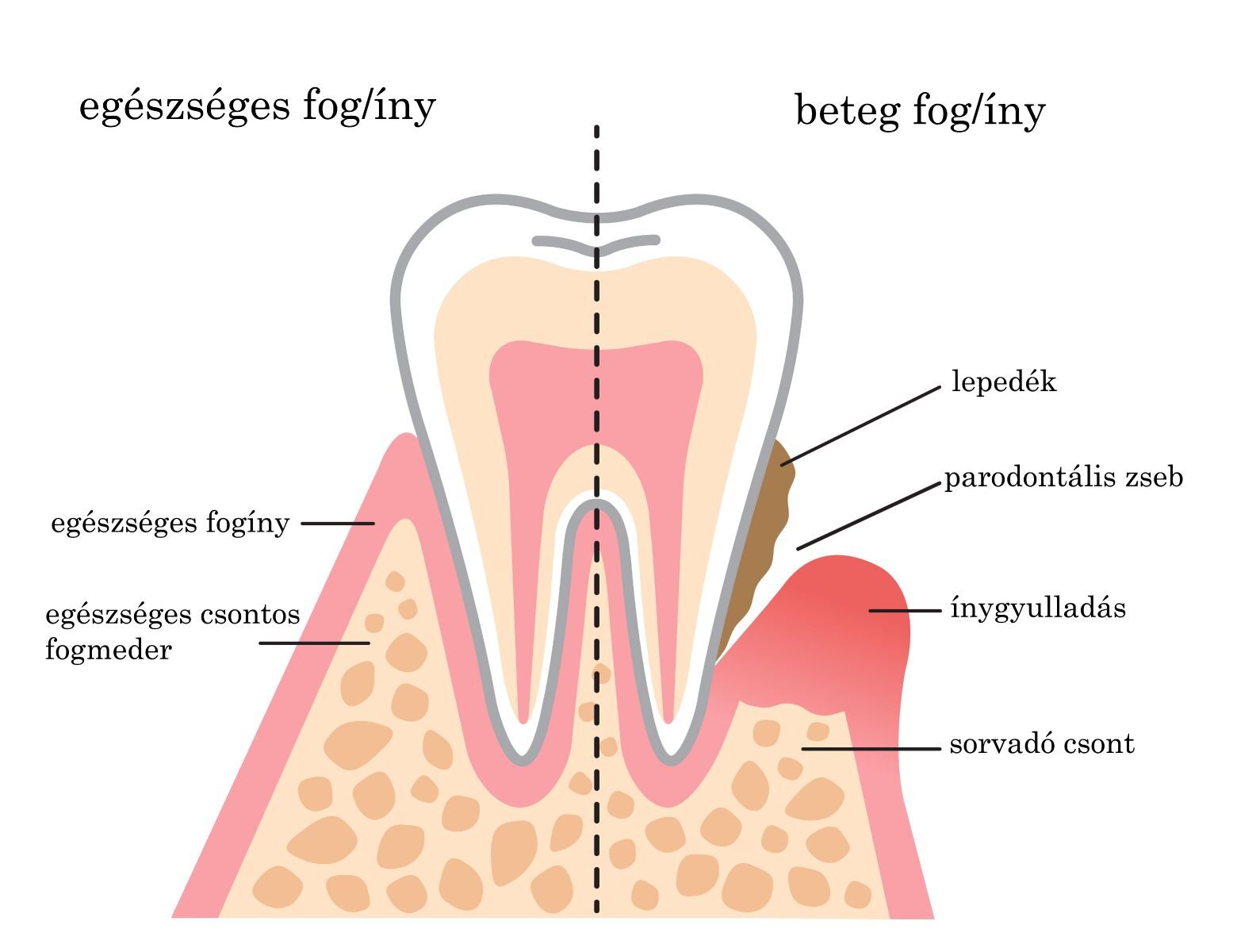 kezelése fogínygyulladás diabetes