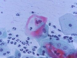 HPV vírusfertőzés mikroszkópos kép