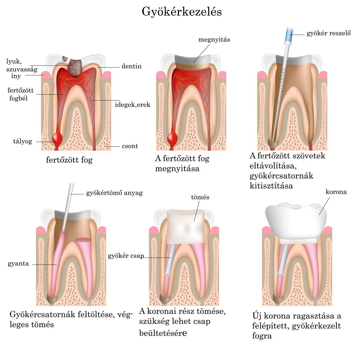 Gyökérkezelés