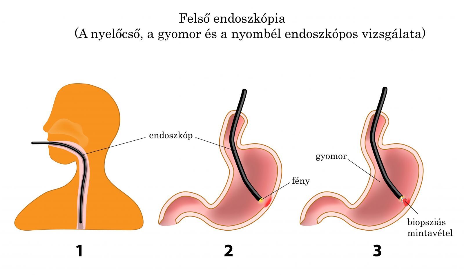 Felső endoszkópia, gyomortükrözéses