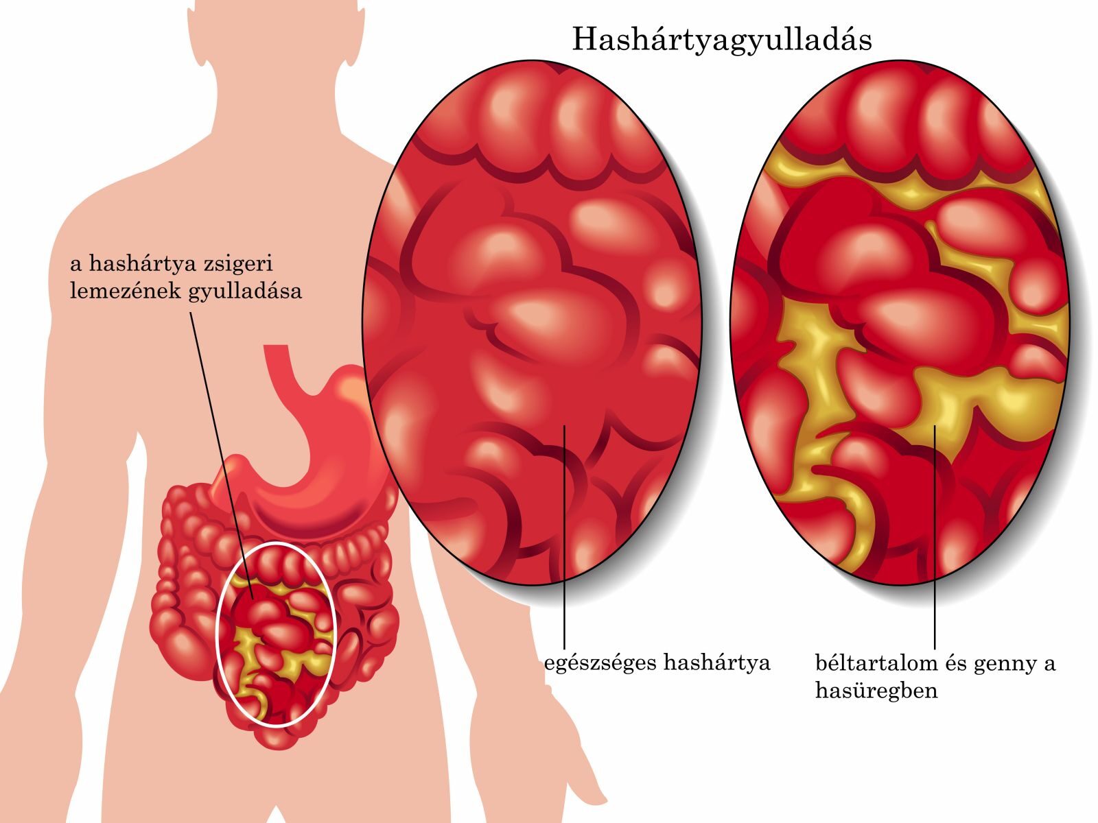 Hashártyagyulladás