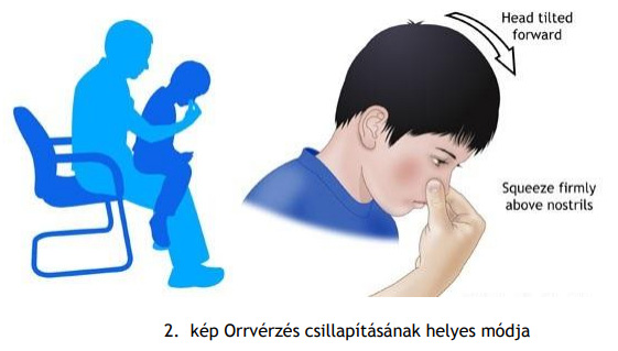 Orrvérzés csillapításának helyes módja