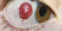 hogyan lehet gyógyítani a látást 13 éves celandin a látás helyreállításához