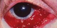 A szem vörössége magas vérnyomással. Szembevérzés tünetei és kezelése