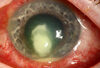 Aspergillus okozta keratitis