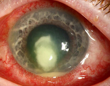 szemészeti keratitis kezelés)