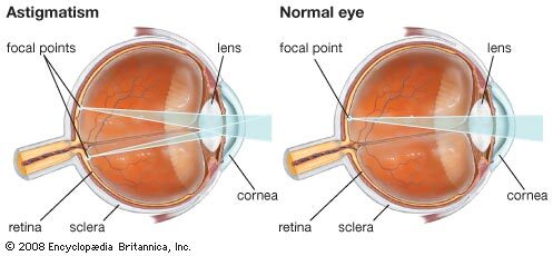 Asztigmiás szem (bal oldalt) és egészséges szem (jobb oldalt), Kép forrása: Enciclopeadia Britannica