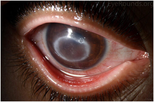 Acanthamoeba-keratitis