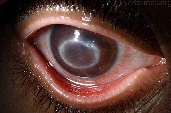 látásélesség herpeszes keratitis esetén