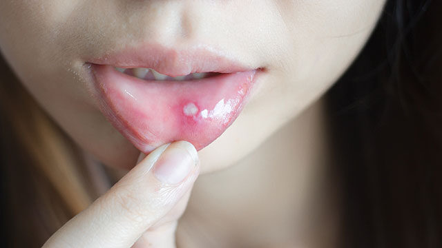 gombás fertőzés szájban