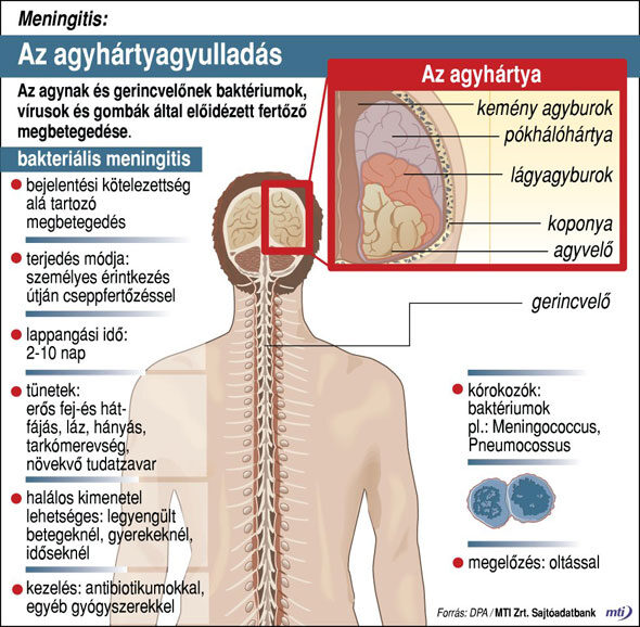 az agyhártyagyulladás hatása a látásra)