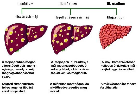 máj cirrhosis cukorbetegséggel)