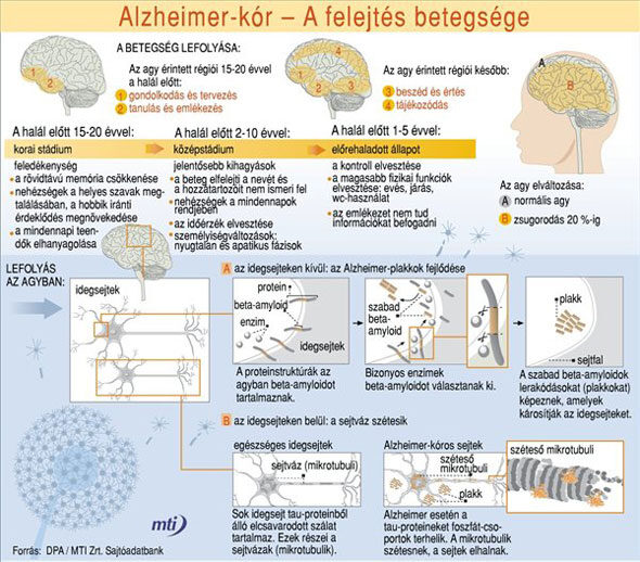 Alzheimer-kór