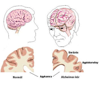 fogyás késői stádiumú alzheimer-kórban szenvedő betegeknél