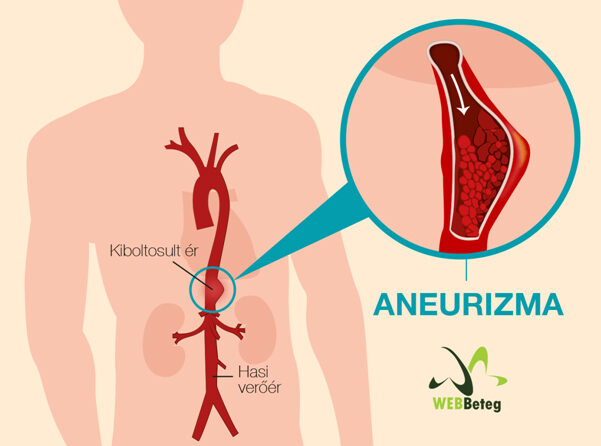 magas vérnyomás aneurysma)