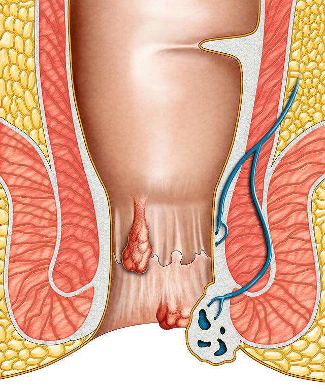 A fekélyes vastagbélgyulladás (colitis ulcerosa)