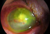 Bacterialis keratitis