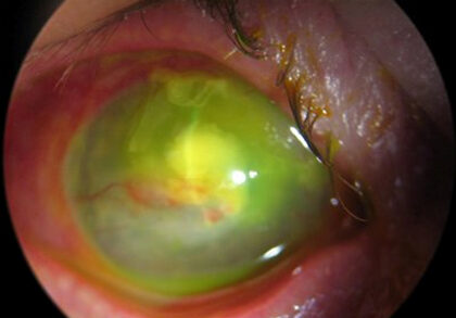 A szem vaszkuláris traktusának vizsgálati módszerei. A szem érrendszere. Az írisz melanoma