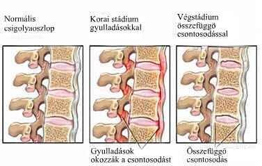 A Bechterew-kór stádiumai