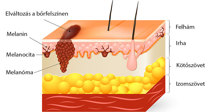 Melanoma