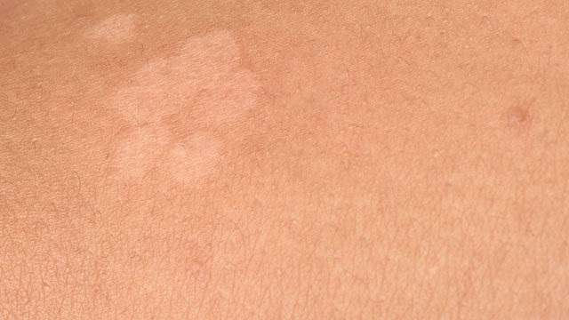 gombás bőr kezelése