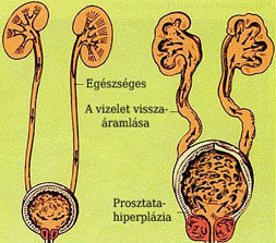 Prostatitis kurkum Prosztata vizelési késleltetéssel