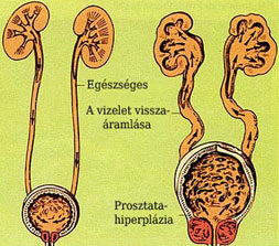 prosztata megnagyobbodás természetes kezelése