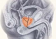 Mycoplasma hominis prostatitis, A prosztatit mucus megkülönböztethető