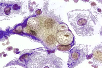Chlamydia trachomatis baktérium mikroszkópos képe