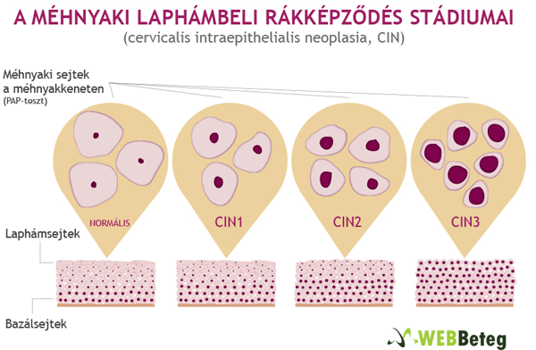 A méhnyaki laphámbeli rákképződés stádiumai