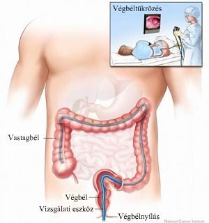 lefogyok a kolonoszkópia után