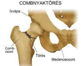 combcsonttörés gyógyulási idő