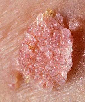 HPV által okozott condyloma acuminatum