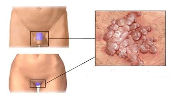 Lichen sclerosus: piros és fehér foltok a nemi szerven: