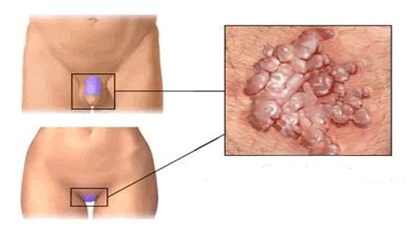 Condyloma a nemi szerveken
