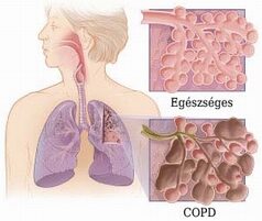 copd kezelés cukorbetegséggel leohanguo kapszula a cukorbetegség kezelésére