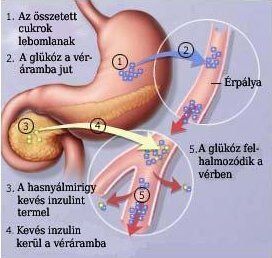 A cukorfelszívódás sémás ábrája 1-es típusú diabétesz esetén