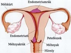 Méhtestrák (endometriumrák) és méhnyakrák