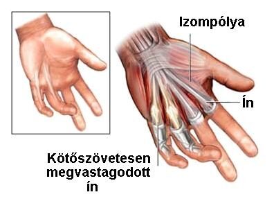 a kézízületek deformáló artrózisa)