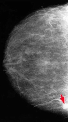 Mammogrammon ábrázolódó emlőtumor; Forrás: http://z.about.com/d/breastcancer