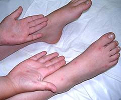 Bőrtünetek Coxsackie-vírus okozta fertőzés esetén