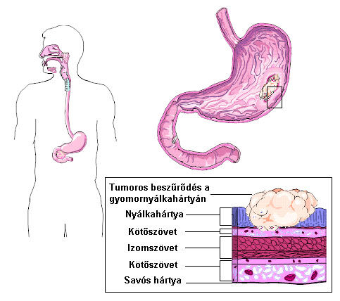 A anatómiai gyomor helyzete és a gyomorrák
